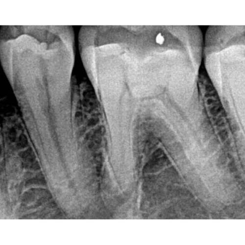 Kodak RVG 5200 - радиовизиограф, 16 пар линий/мм | Carestream Dental (США)