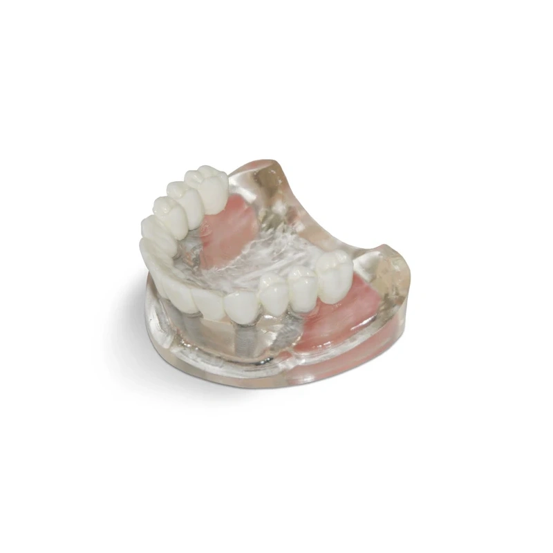 T10 – демонстрационная модель верхней челюсти с 6 имплантами и протезом | GF Dental (Италия)