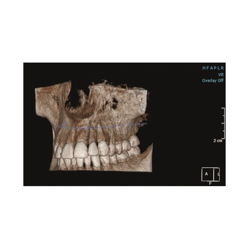 KaVo Pan eXam Plus 3D Ceph (2 датчика) - универсальный датчик Pan/Ceph для панорамной томографии, цефалостат, функция 3D-томографии 6x8 см | KaVo (Германия)