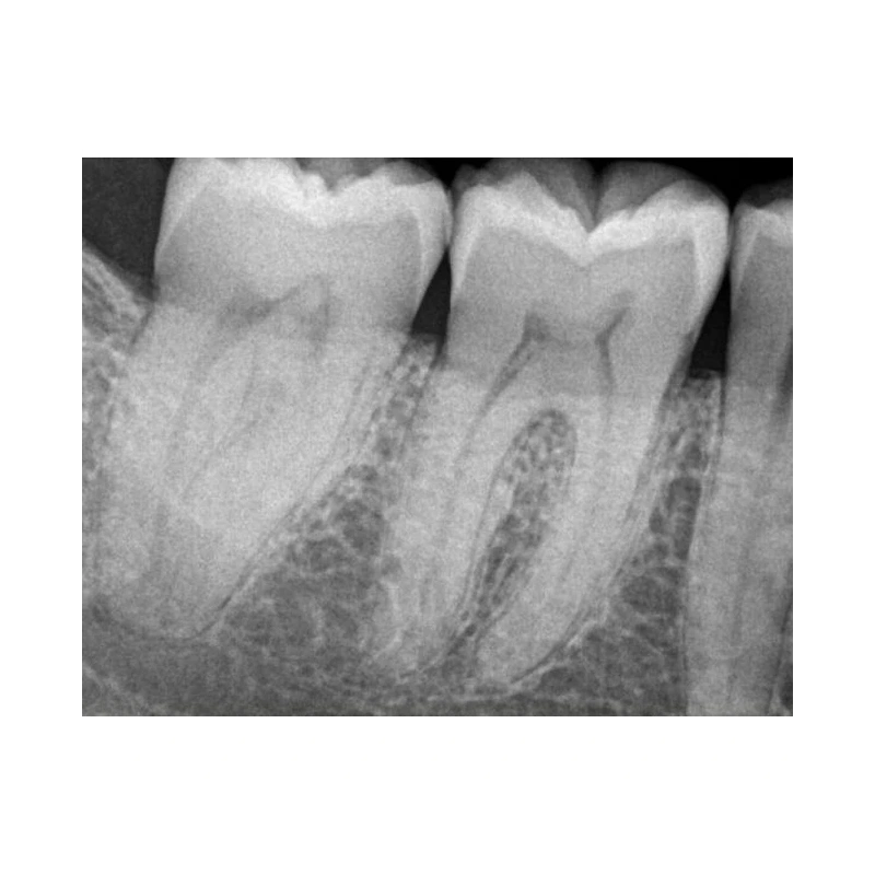 Kodak RVG 6200 - радиовизиограф, 24 пар линий/мм | Carestream Dental (США)