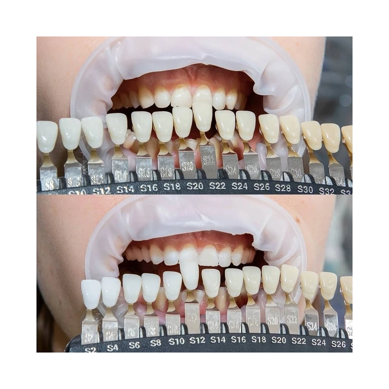 Amazing White Premium Teeth Whitening Kit 38% - набор для клинического отбеливания | Amazing White (США)