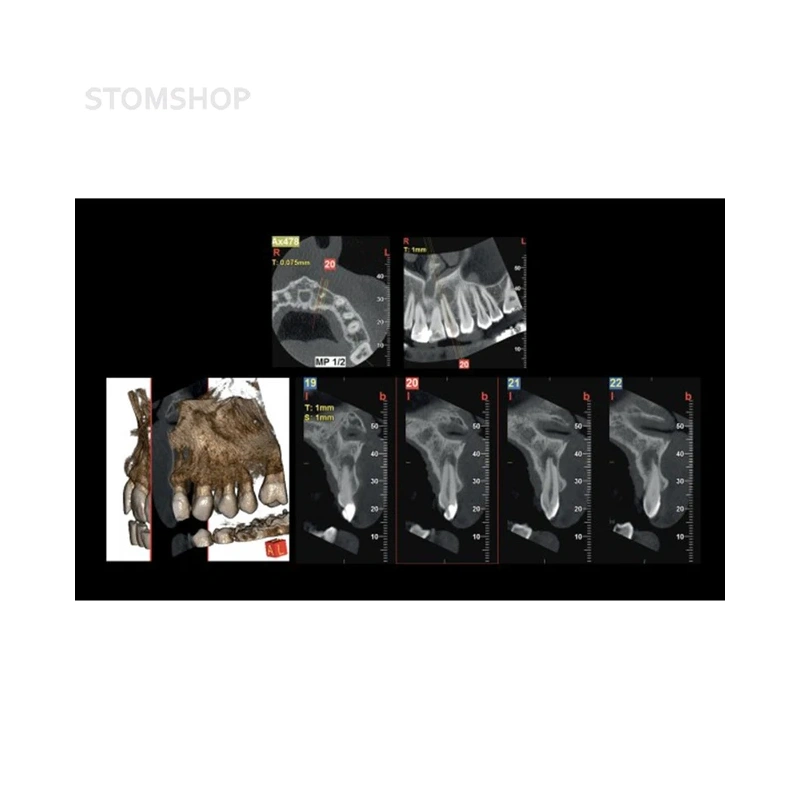 Hyperion X9 Pro 11x13 - дентальный цифровой 3D-томограф с цефалостатом, 3 в 1, FOV 11x13 | MyRay (Италия)