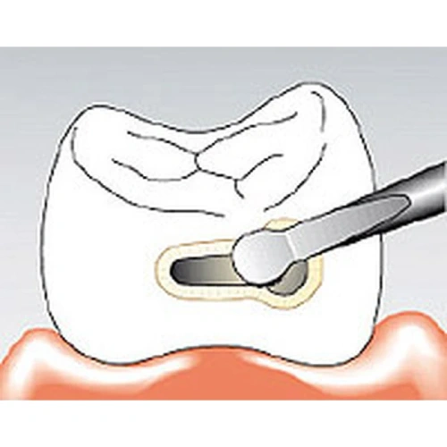 Sonicflex micro №30 A - насадка для минимально инвазивной терапии кариеса с алмазным покрытием, малая полусфера | KaVo (Германия)