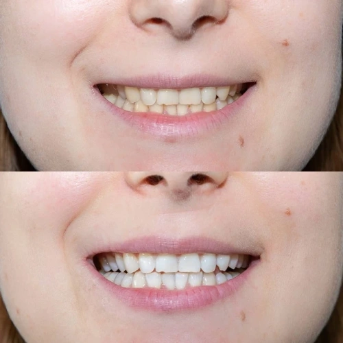 Amazing White Premium Teeth Whitening Kit 38% - набор для клинического отбеливания | Amazing White (США)