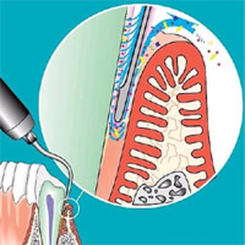 Sonicflex paro №60 - длинная прямая насадка с закругленной верхушкой для минимально инвазивной терапии пародонтита | KaVo (Германия)