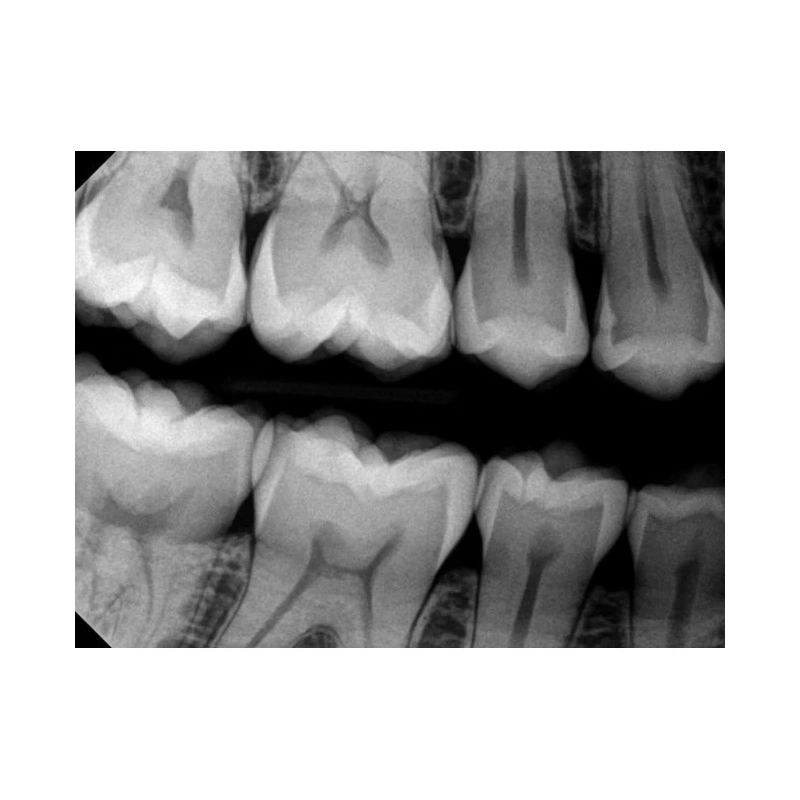 Kodak RVG 6200 - радиовизиограф, 24 пар линий/мм | Carestream Dental (США)
