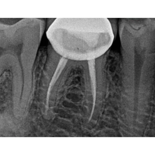 Kodak RVG 5200 - радиовизиограф, 16 пар линий/мм | Carestream Dental (США)