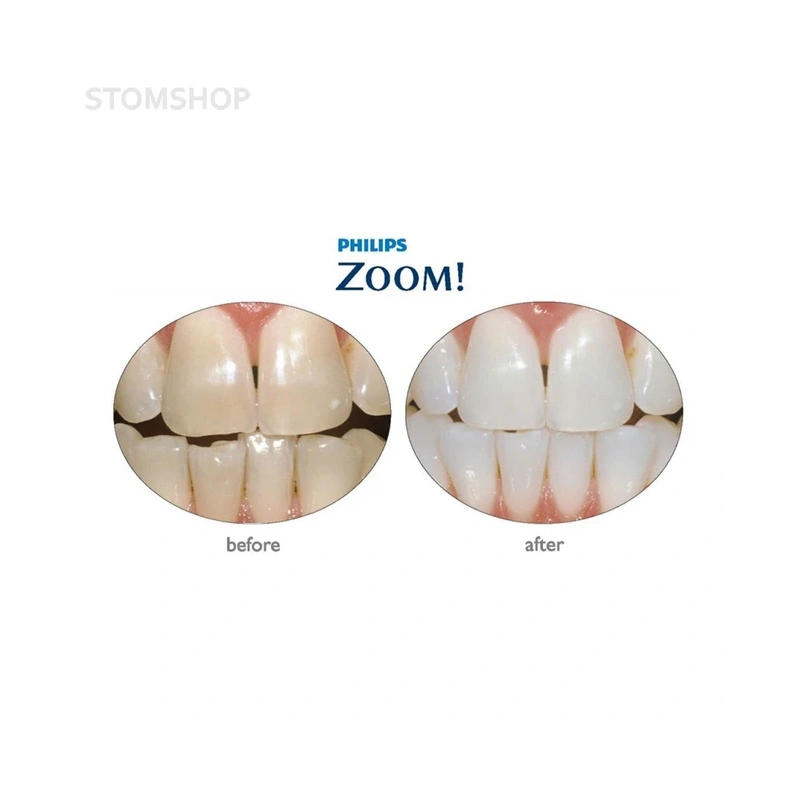Philips Zoom! Chairside Single Kit - одинарный набор для отбеливания с улучшенным гелем (для 1 пациента) | Philips (Нидерланды)