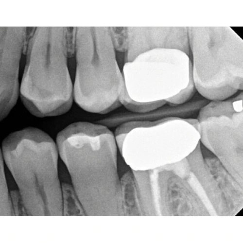 Kodak RVG 6200 - радиовизиограф, 24 пар линий/мм | Carestream Dental (США)