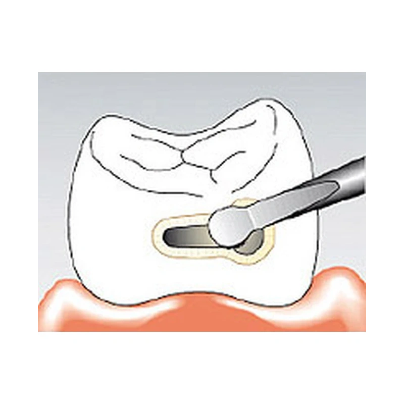 Sonicflex bevel №58 A - насадка для минимально инвазивной терапии кариеса с алмазным покрытием, мезиальная | KaVo (Германия)