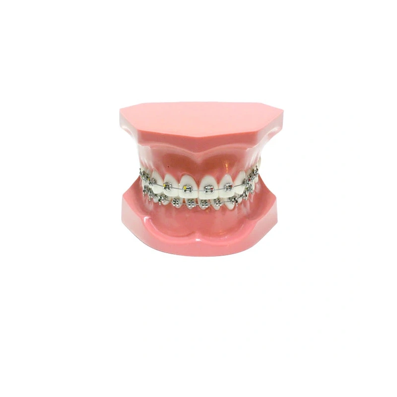 ORB01 – ортодонтическая модель с брекетами и твердой десной, 1 класс | GF Dental (Италия)