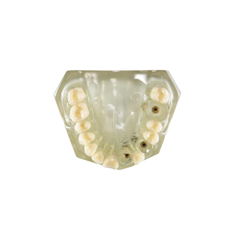 CRYSTAL IMPLANT MODEL - модель для демонстрации установки имплантатов | Hanil (Ю. Корея)