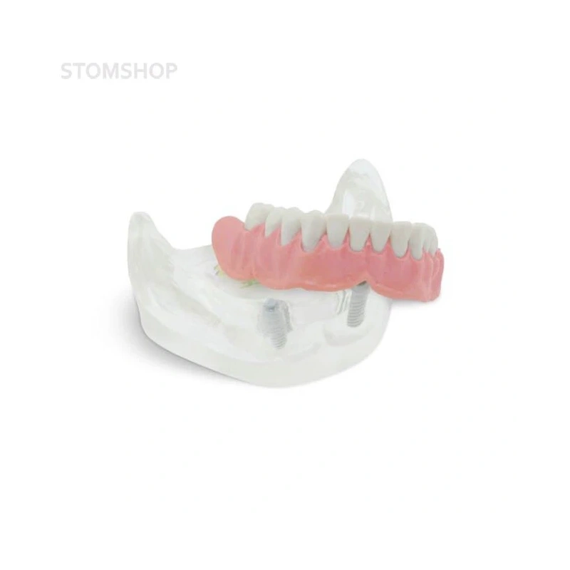 T11 – демонстрационная модель нижней челюсти с имплантами | GF Dental (Италия)