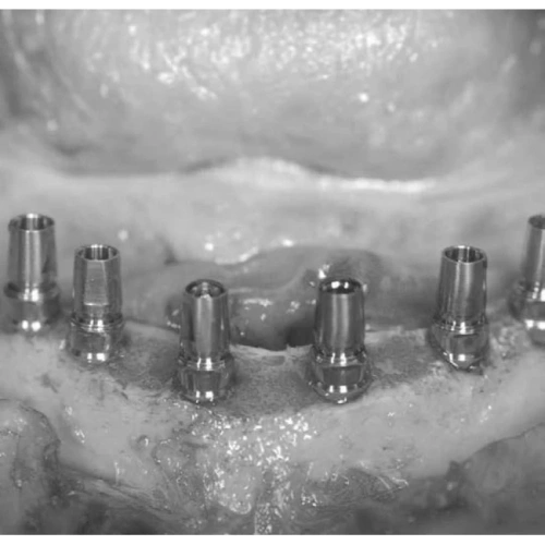 LM Implant Misura MR 3.1-5.3 - инструмент для позиционирования имплантатов | LM-Instruments Oy (Финляндия)