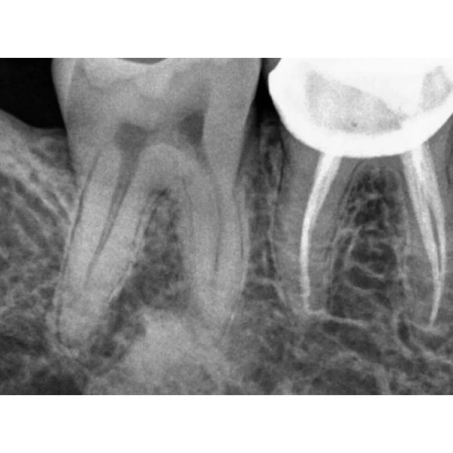Kodak RVG 5200 - радиовизиограф, 16 пар линий/мм | Carestream Dental (США)