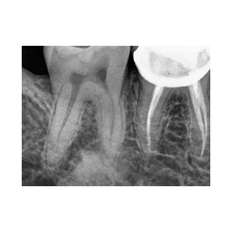 Kodak RVG 5200 - радиовизиограф, 16 пар линий/мм | Carestream Dental (США)