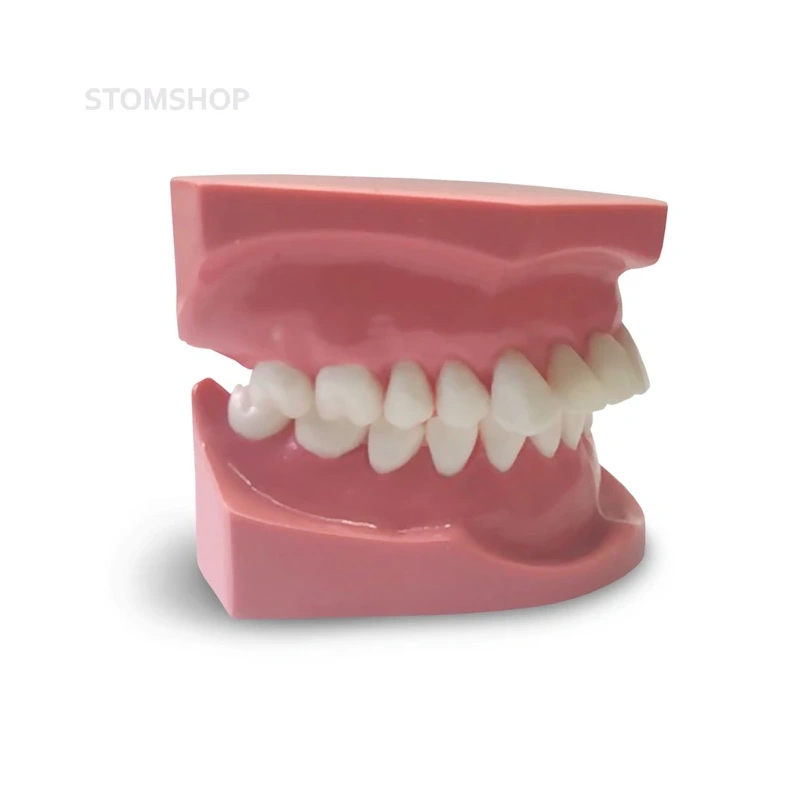 ORB03 – ортодонтическая модель с брекетами и твердой десной, 2 класс | GF Dental (Италия)