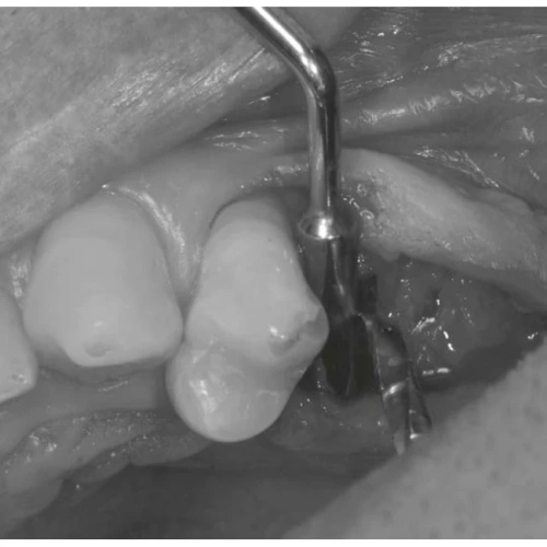 LM Implant Misura MR 3.7-6.3 - инструмент для позиционирования имплантатов | LM-Instruments Oy (Финляндия)