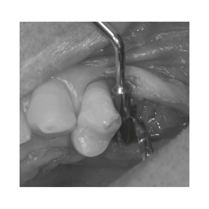 LM Implant Misura MR 3.7-6.3 - инструмент для позиционирования имплантатов | LM-Instruments Oy (Финляндия)